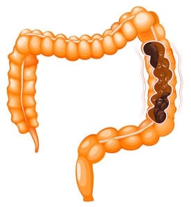 Cauzele constipației intestinale